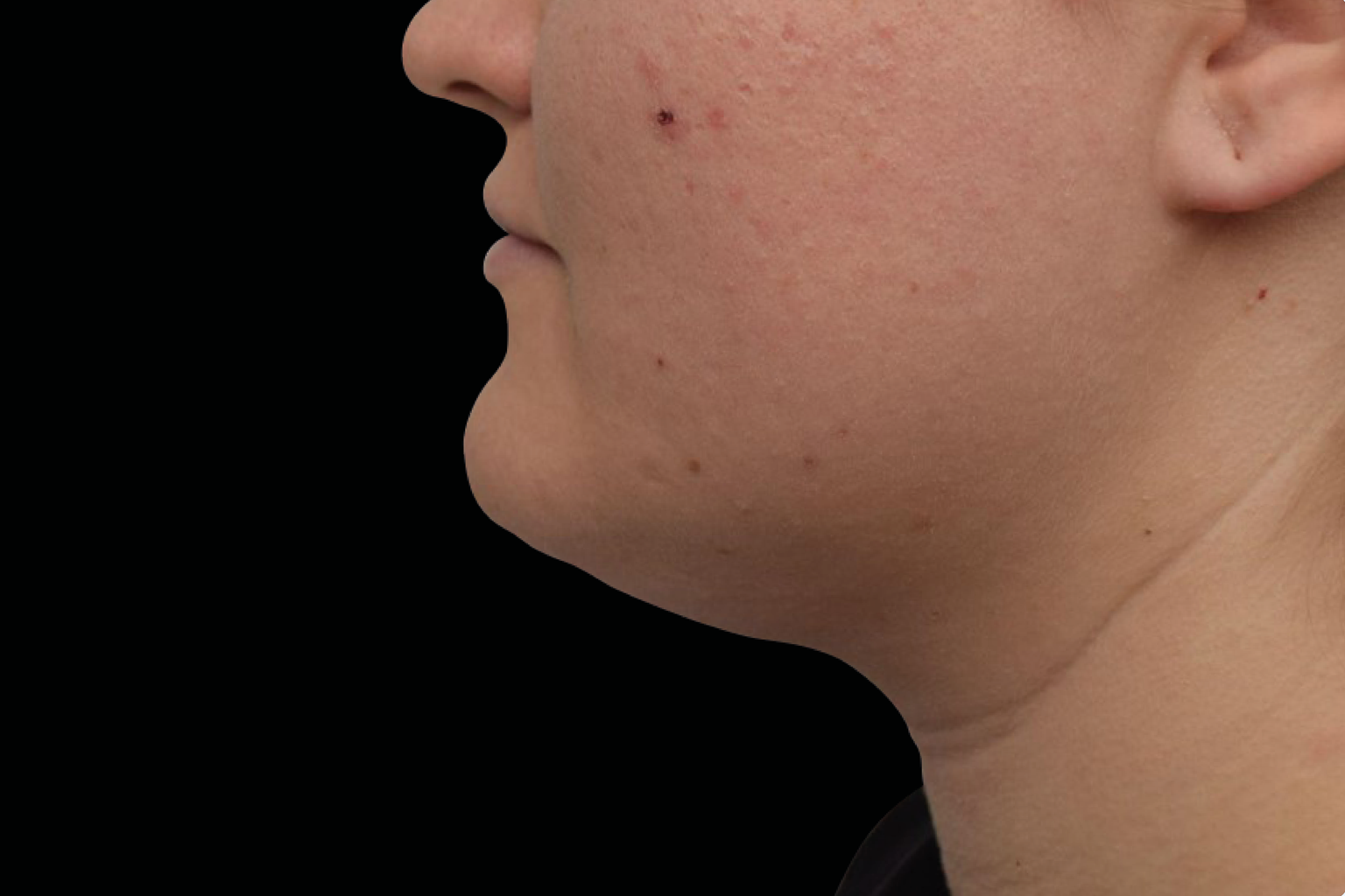 Side profile of a person’s face and neck against a black background, showing visible skin blemishes.