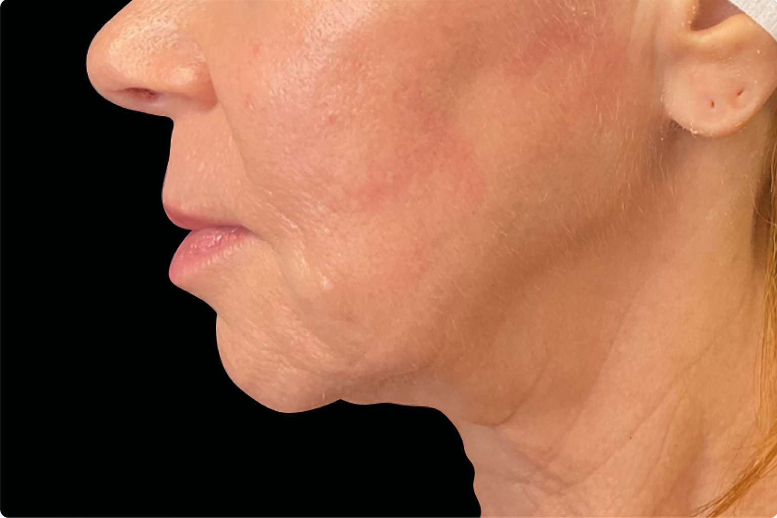 Side profile of a person’s face and neck against a black background, showing skin texture and jawline.
