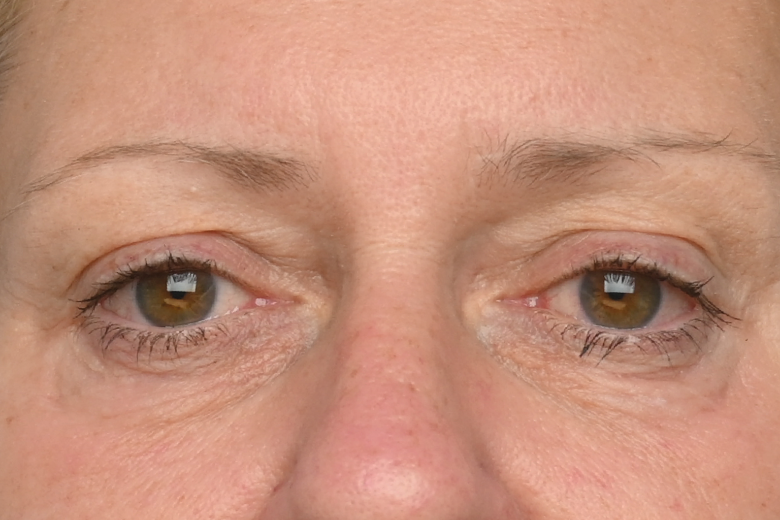 Close-up of a person's eyes and upper face, looking forward with a neutral expression
