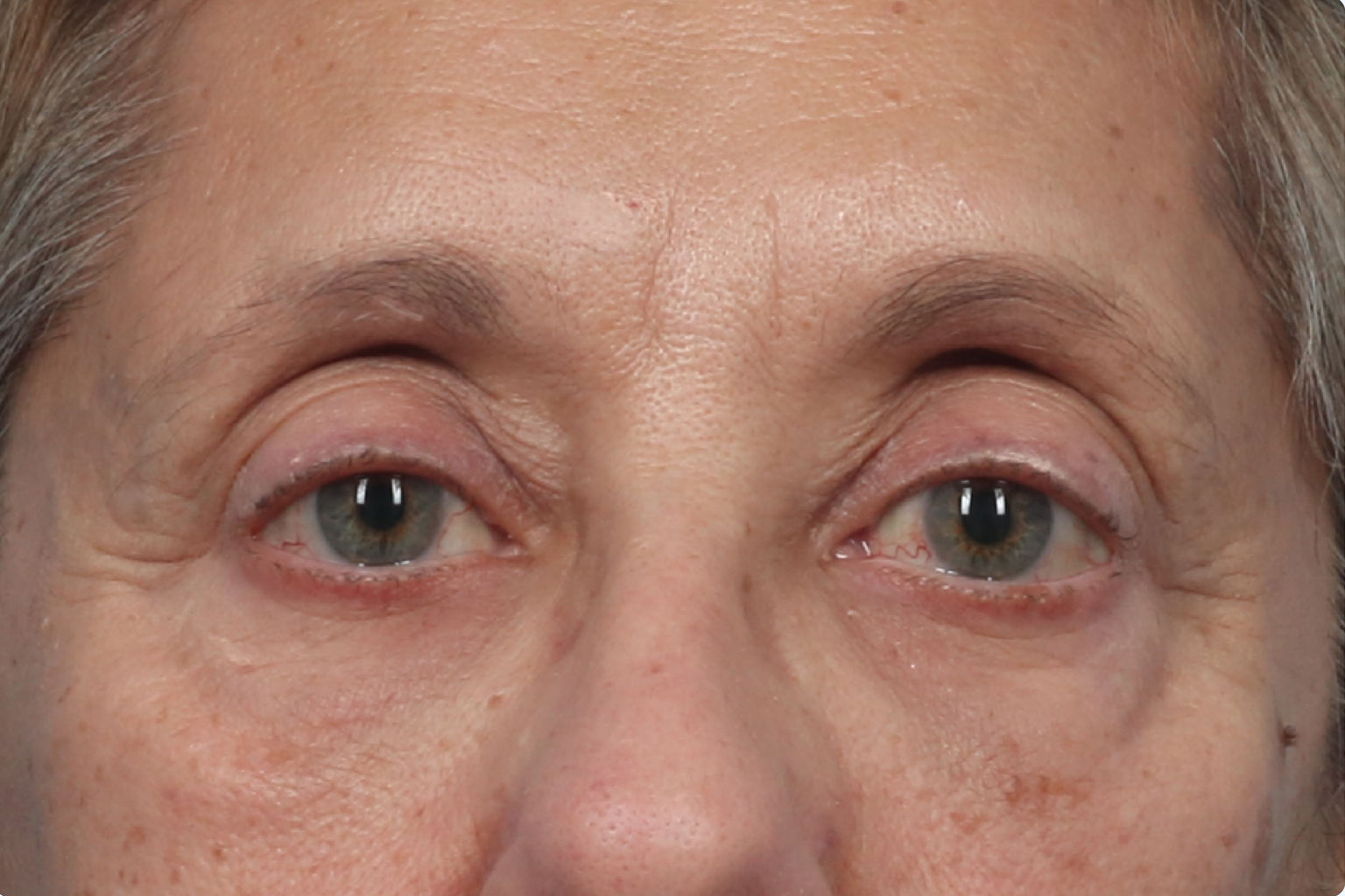 Close-up of a person’s eyes and upper face, with puffy eyelids and red, tired-looking skin