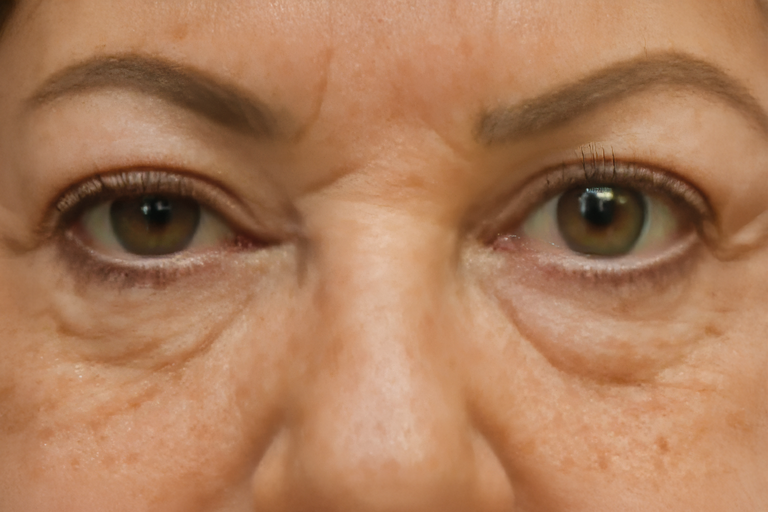 Close-up of a person’s eyes and nose bridge with visible wrinkles and freckles