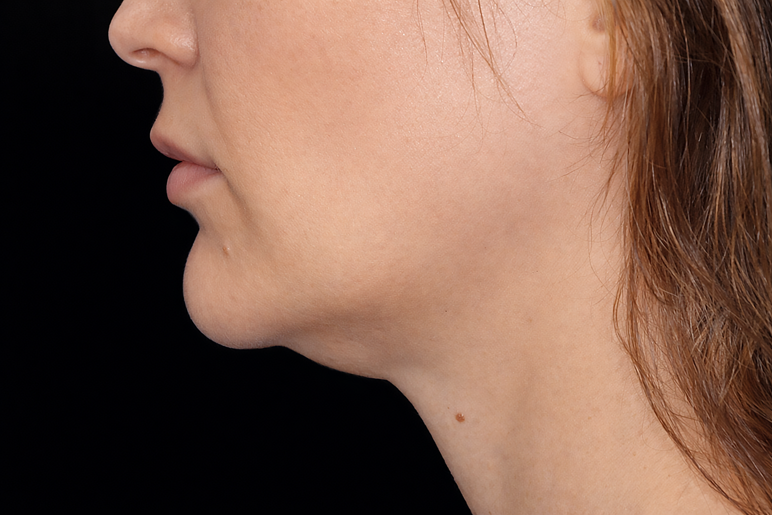 Profile view of a person's face and neck, showing a double chin against a black background.