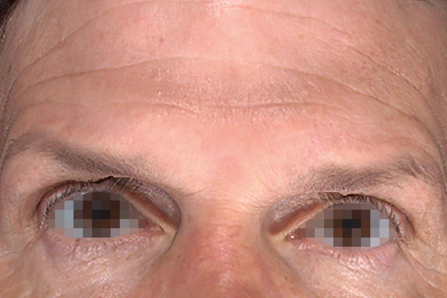 Close-up of a person’s eyes and forehead with pixelated pupils