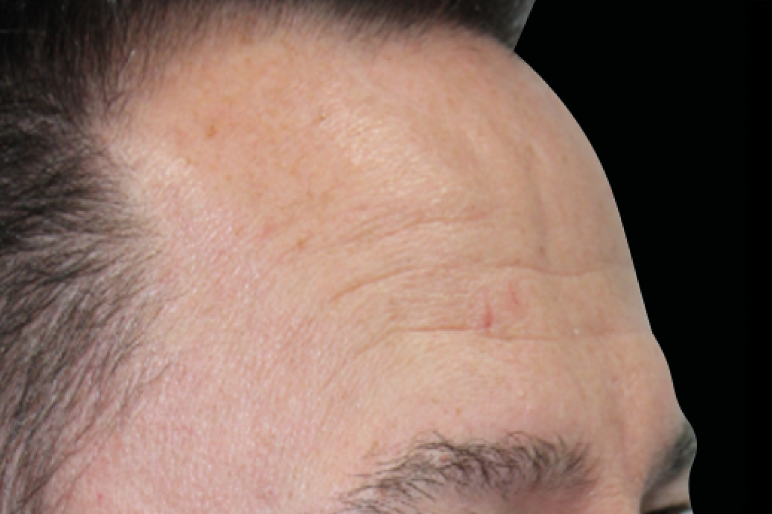 Close-up of a forehead with visible fine lines and a small red mark near the hairline
