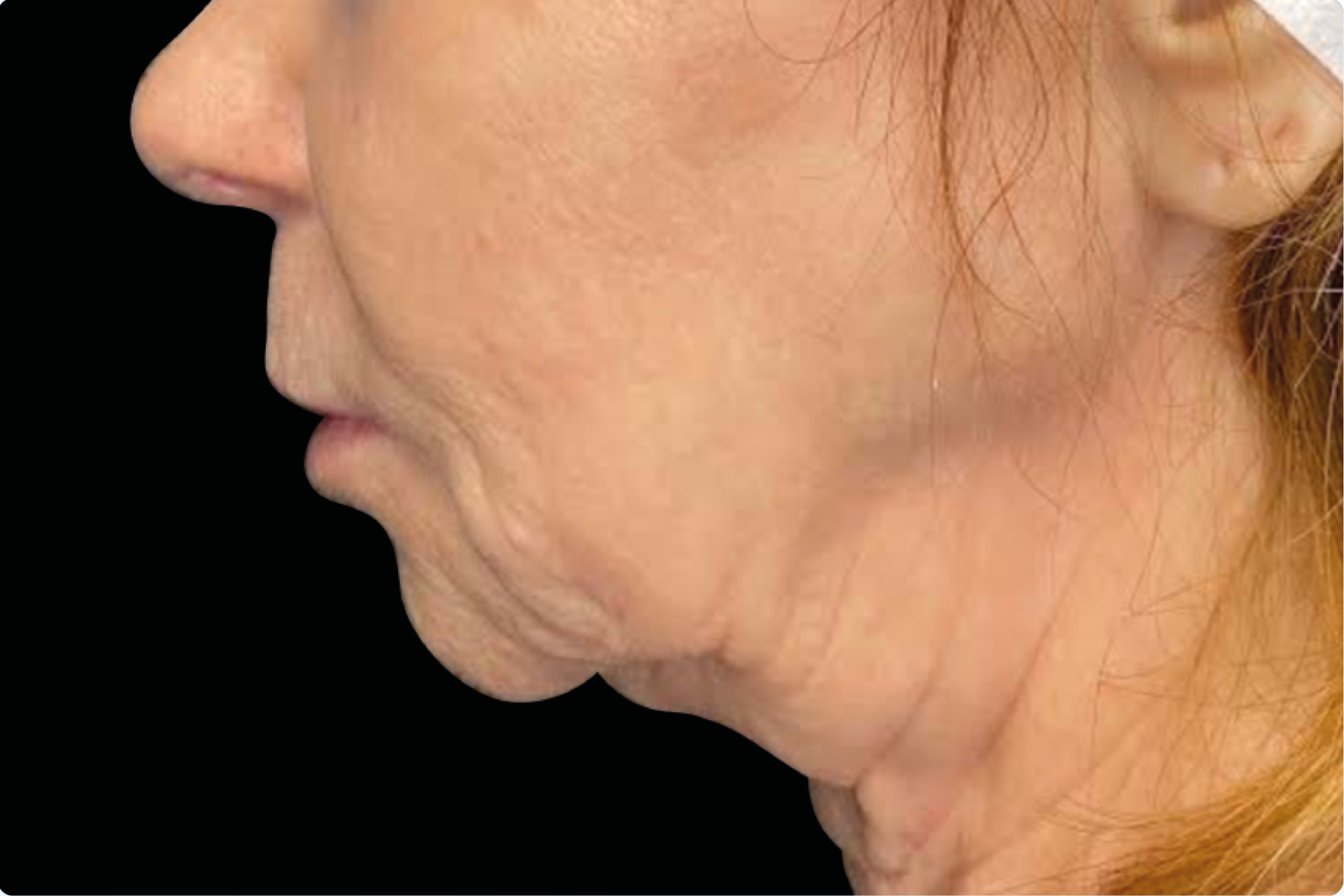 Side profile of a person’s face with visible sagging skin along the jaw and neck on a black background