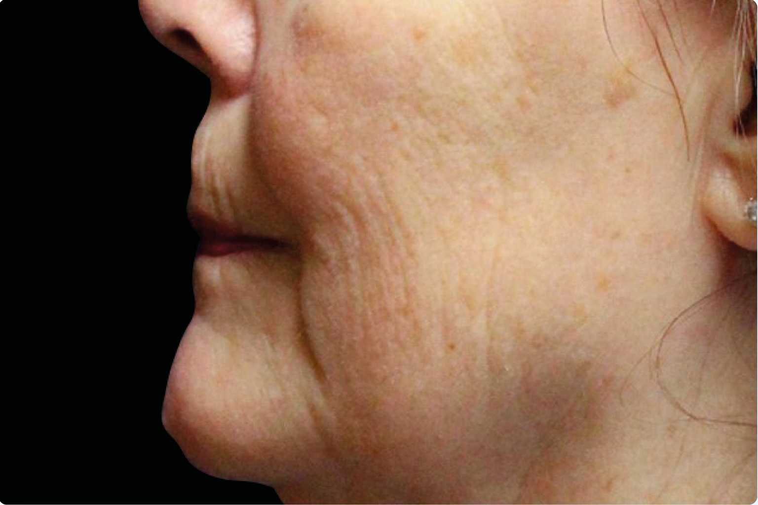 Side profile of a person’s face with visible dark facial hair on the upper lip and chin.