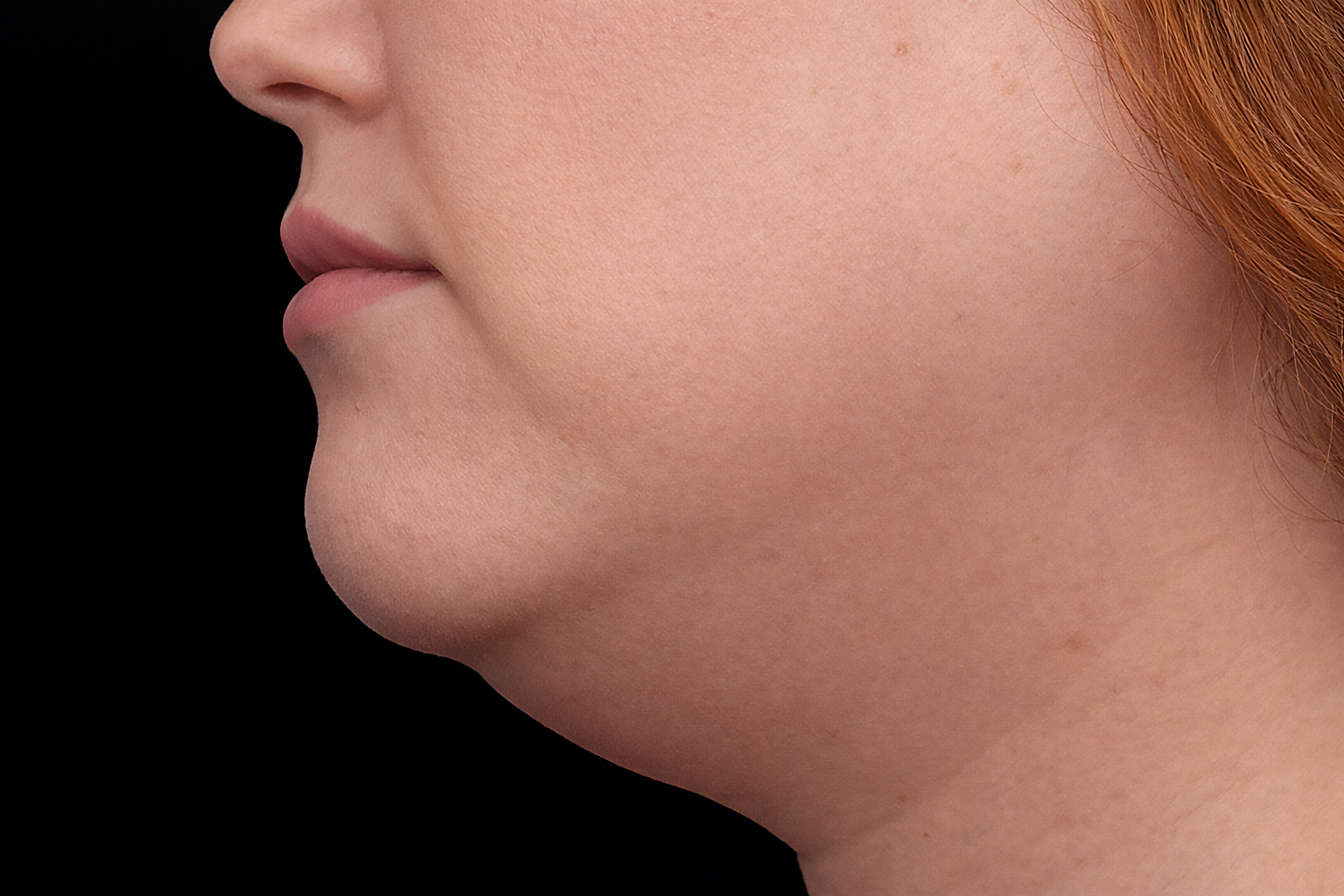 Profile view of a person's chin and neck with visible double chin against a black background.
