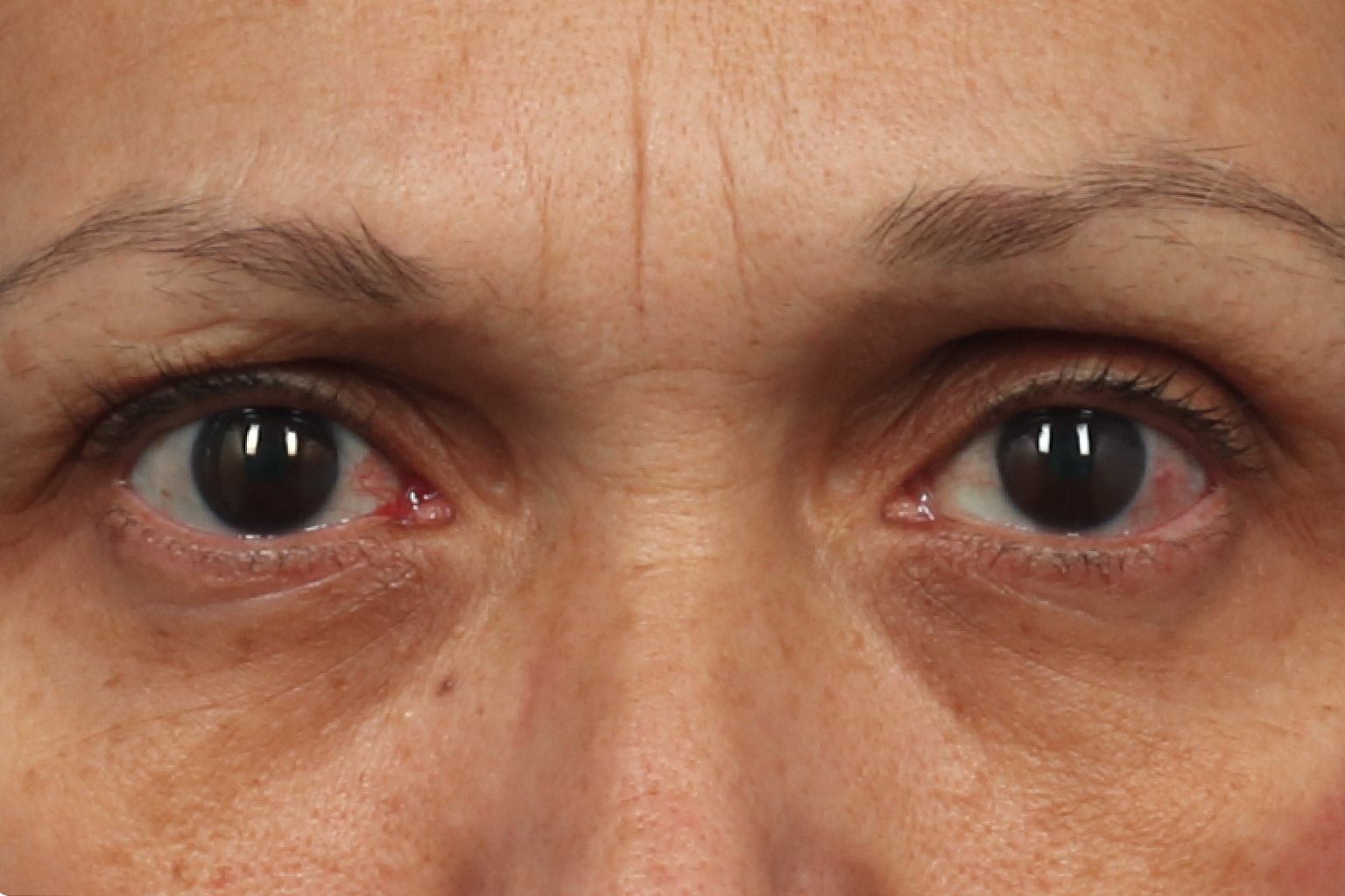 Close-up of a person's eyes with mild redness and dark circles