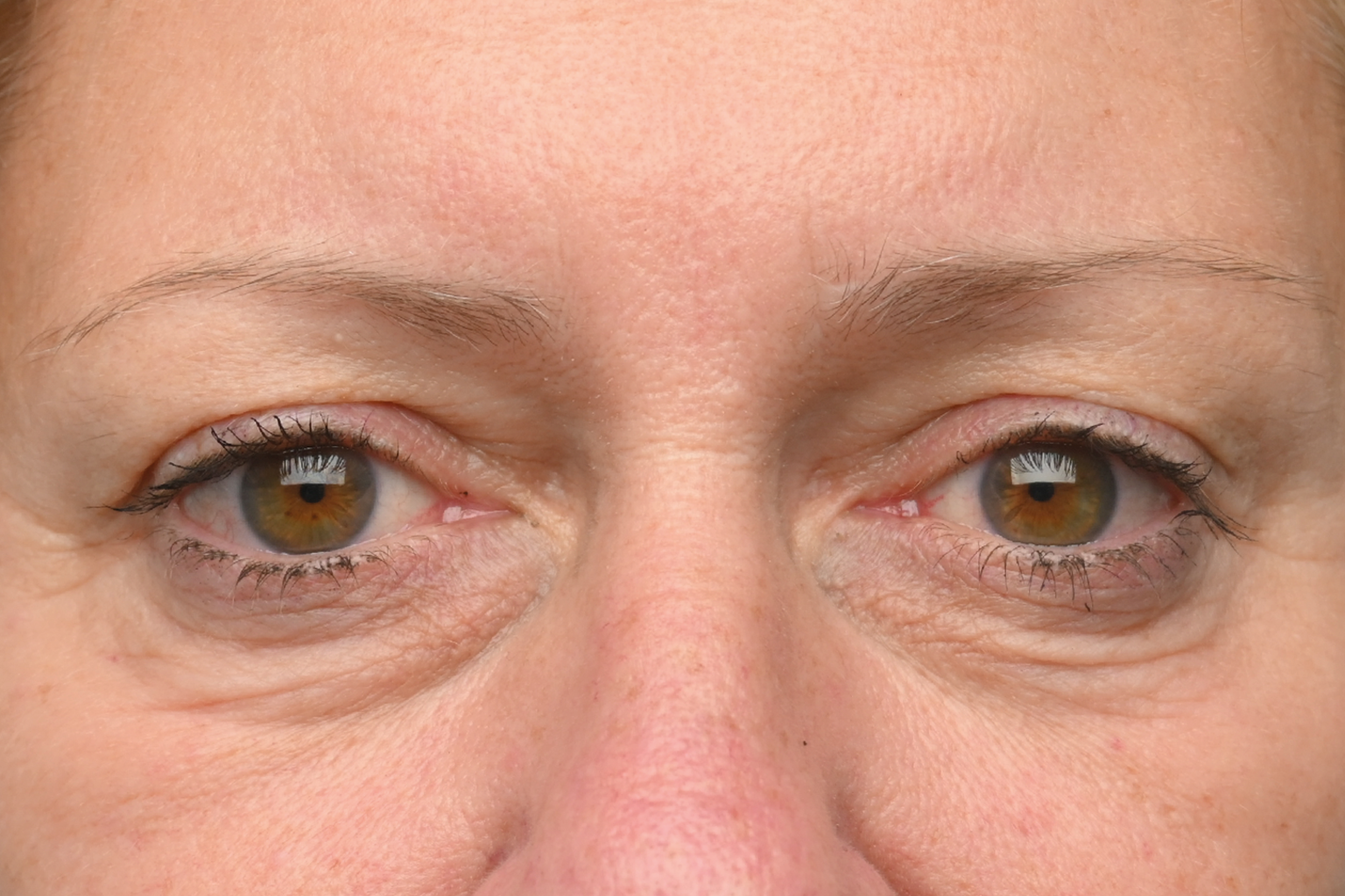 Close-up of a person’s eyes with dark circles and slight puffiness around them