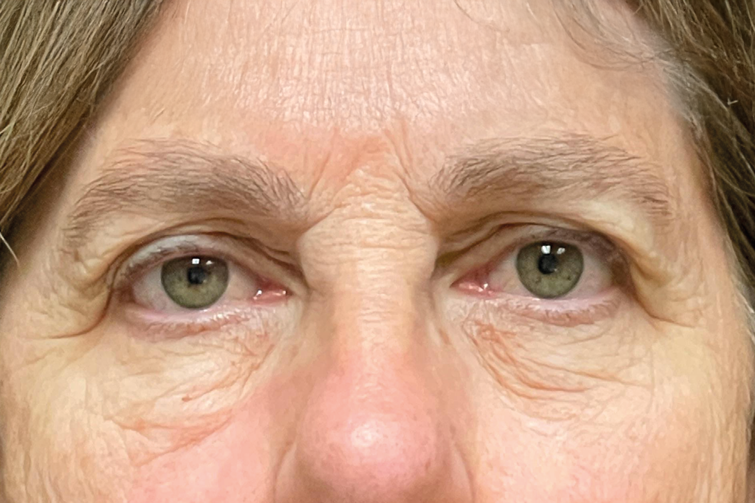 Close-up of a woman's eyes and upper face with a pink nose and light wrinkles