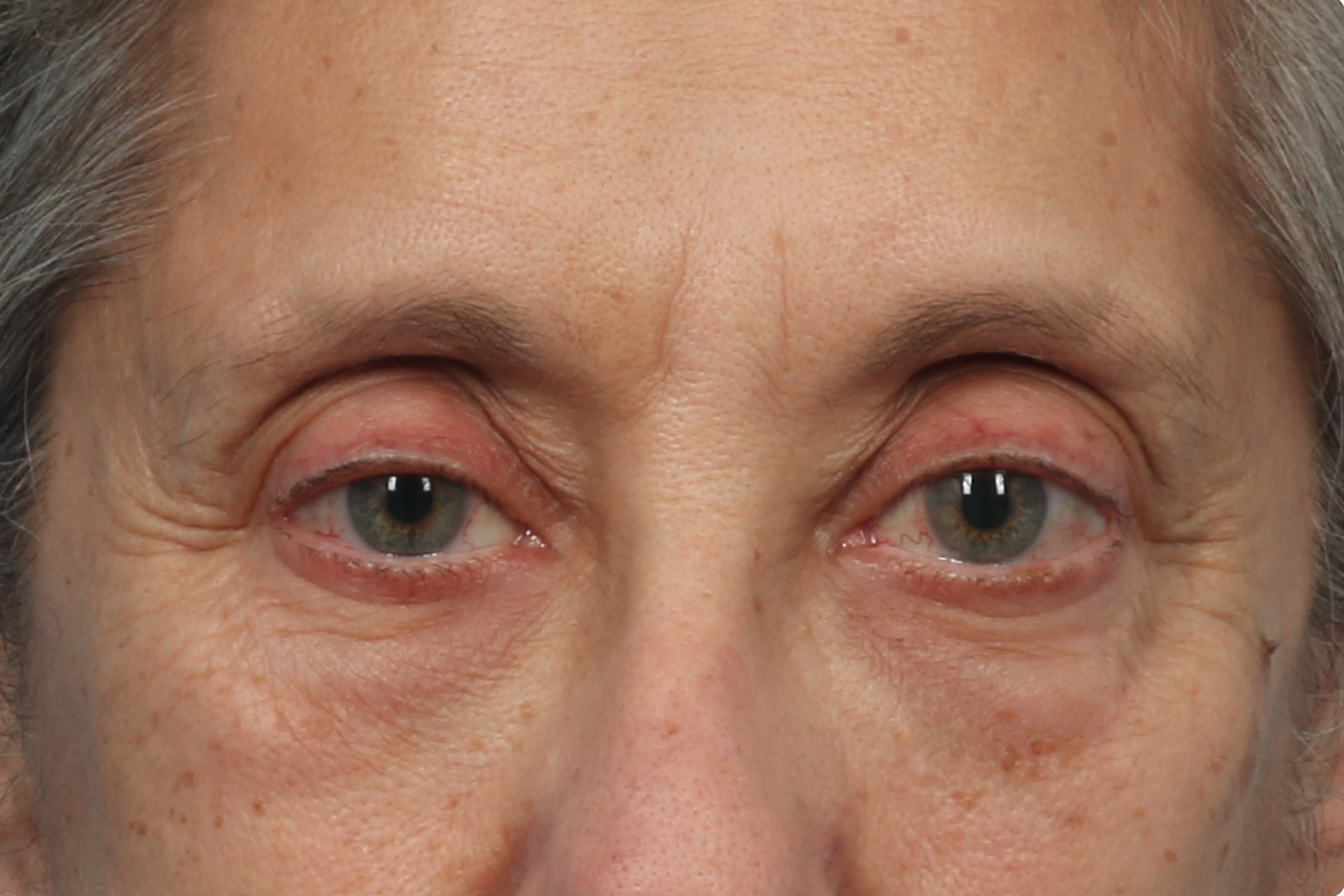 Close-up of a face with puffy, red-rimmed eyes and visible under-eye swelling.