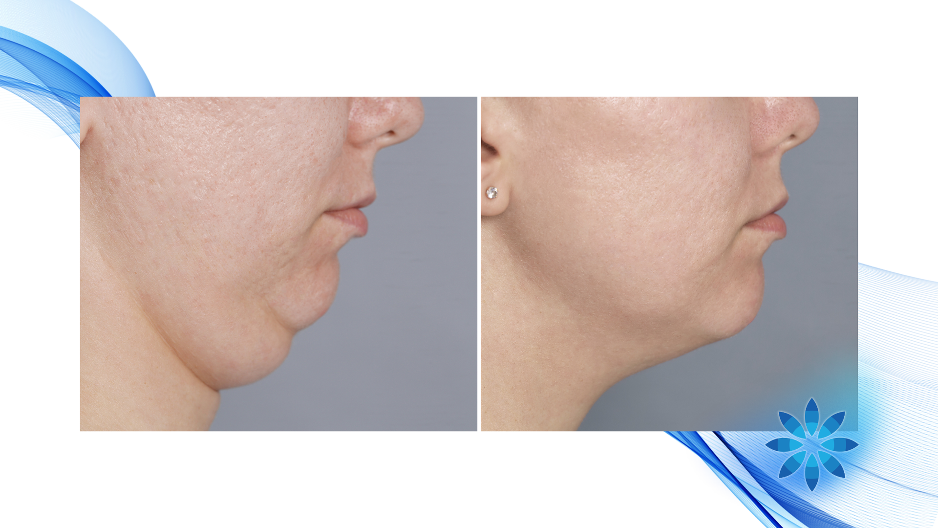 Before and after profile views of a person's neck, showing reduction of a double chin.