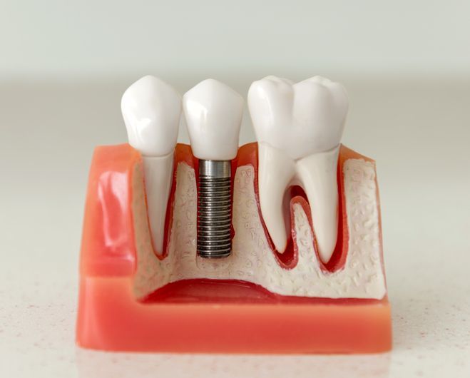 Danties modelis su danties implantu.
