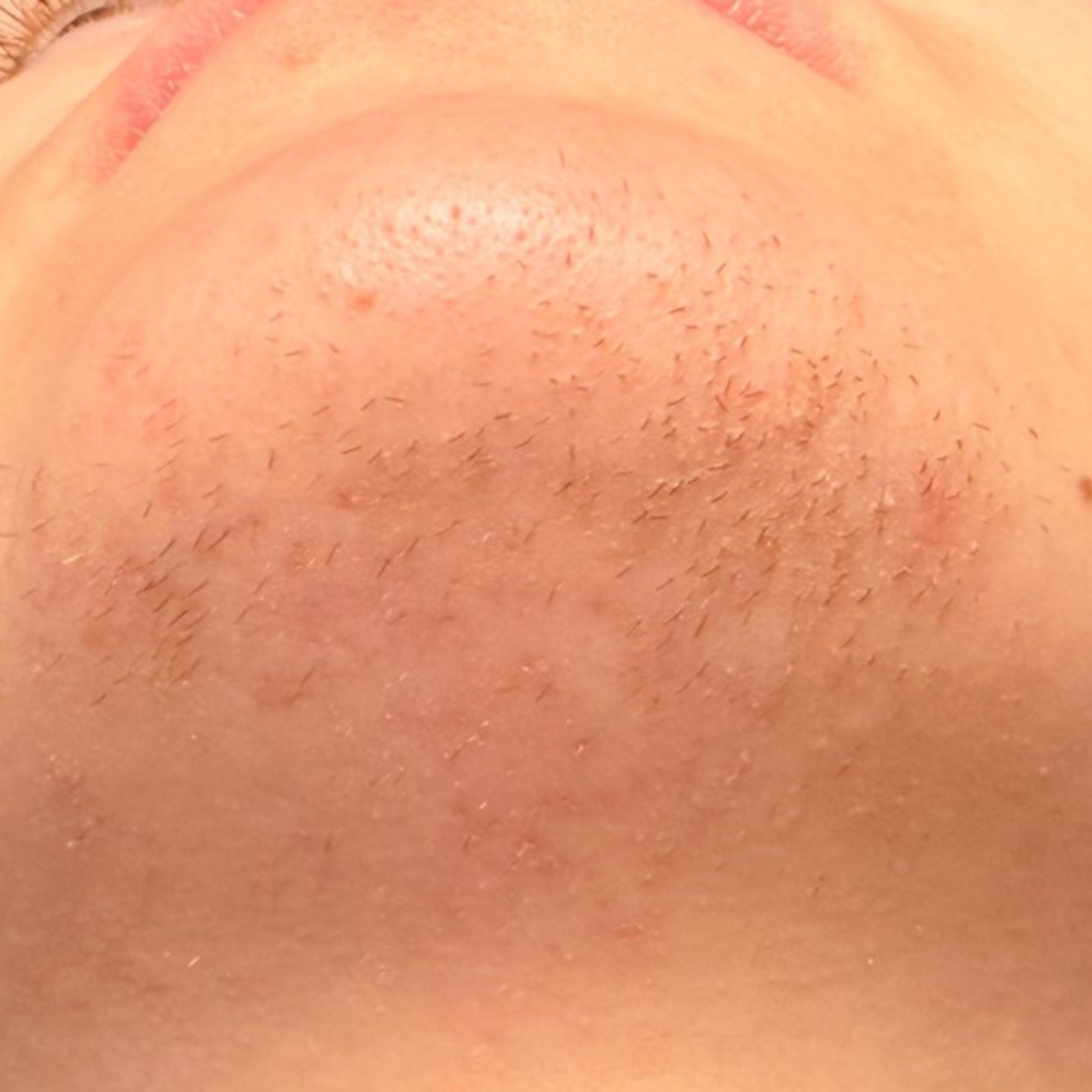 Nadelepilation Elektroepilation Berlin