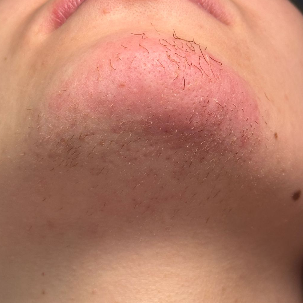 Nadelepilation Elektroepilation Berlin