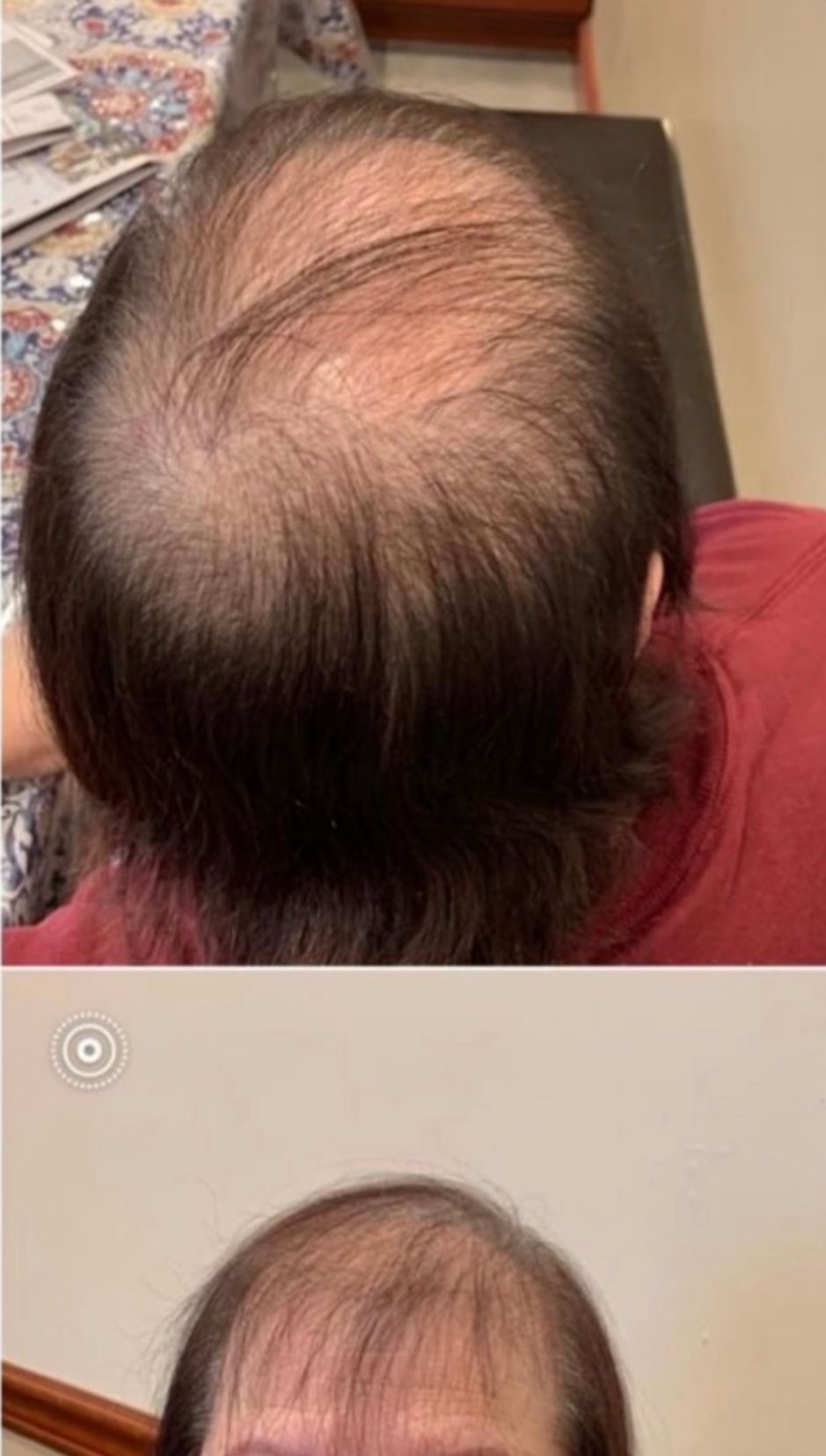 Top-down and front views showing thinning hair on the scalp and hairline.