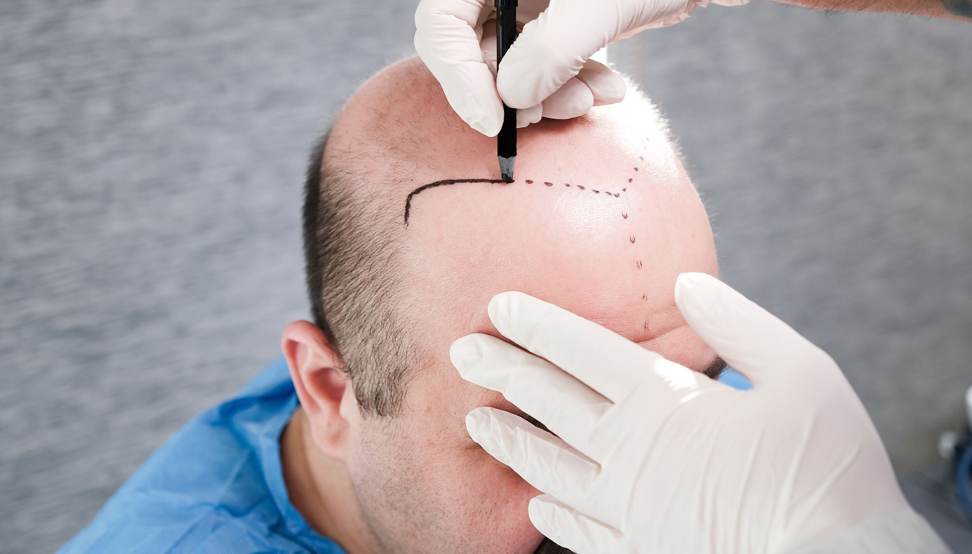 Man's head marked for hair transplant; gloved hands draw hairline with pen.