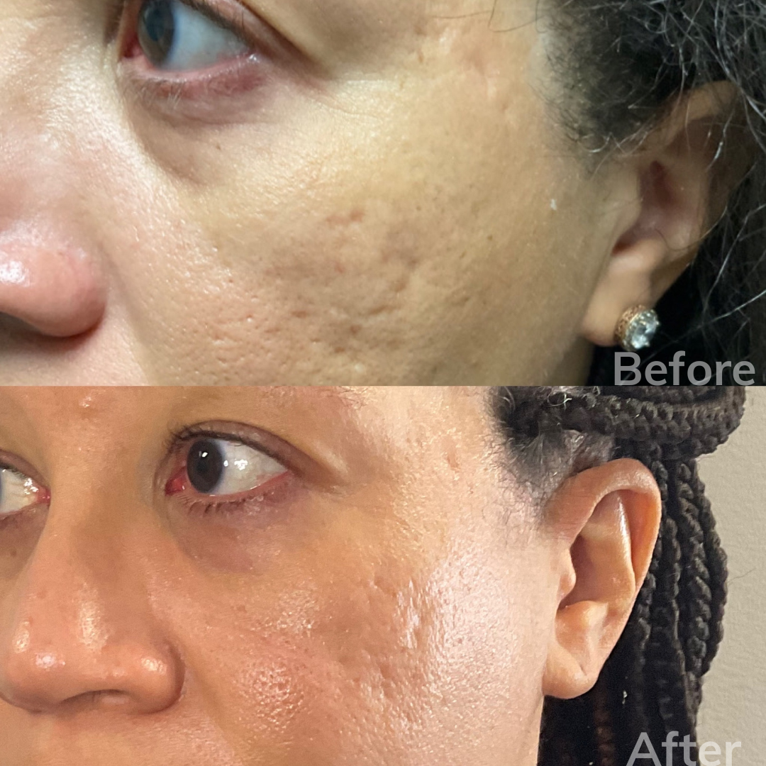 A before and after photo of a woman 's face