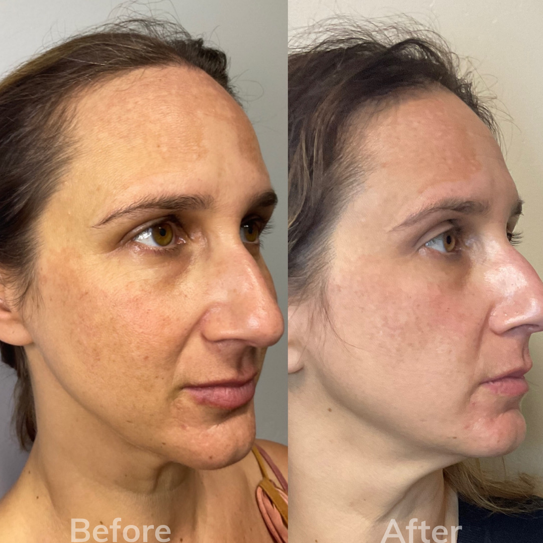 Cosmetic Filler San Marcos