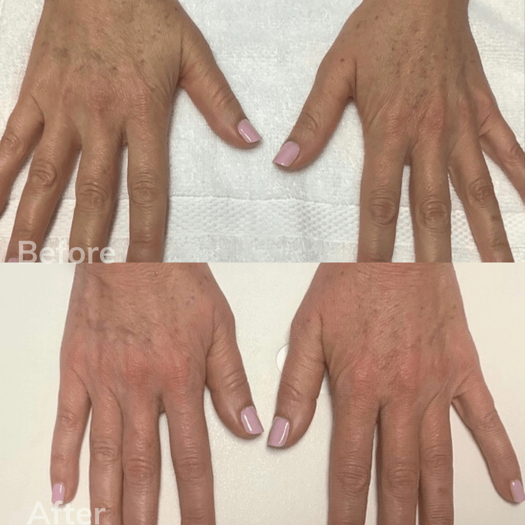 Dermal Fillers Carlsbad