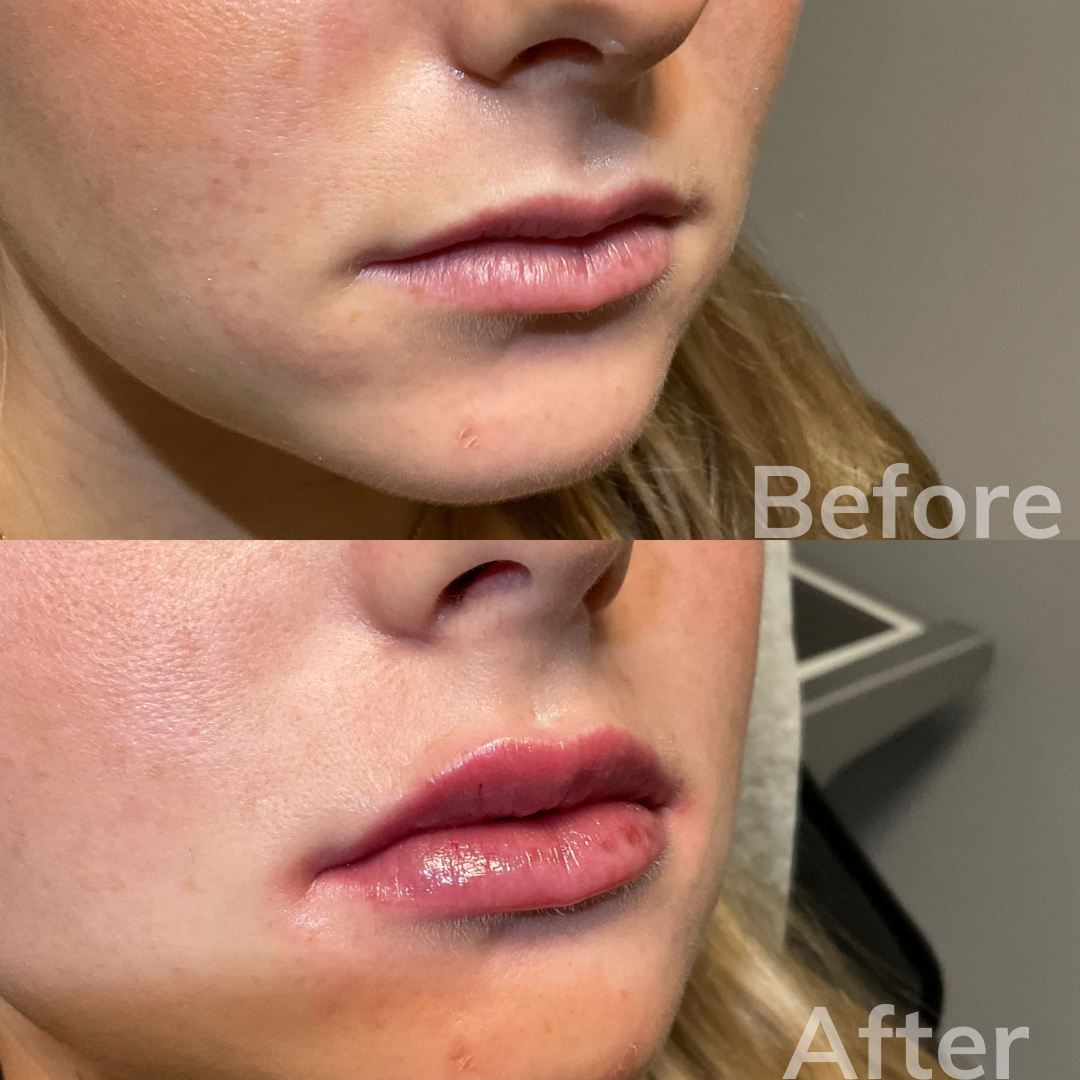 San Marcos dermal fillers