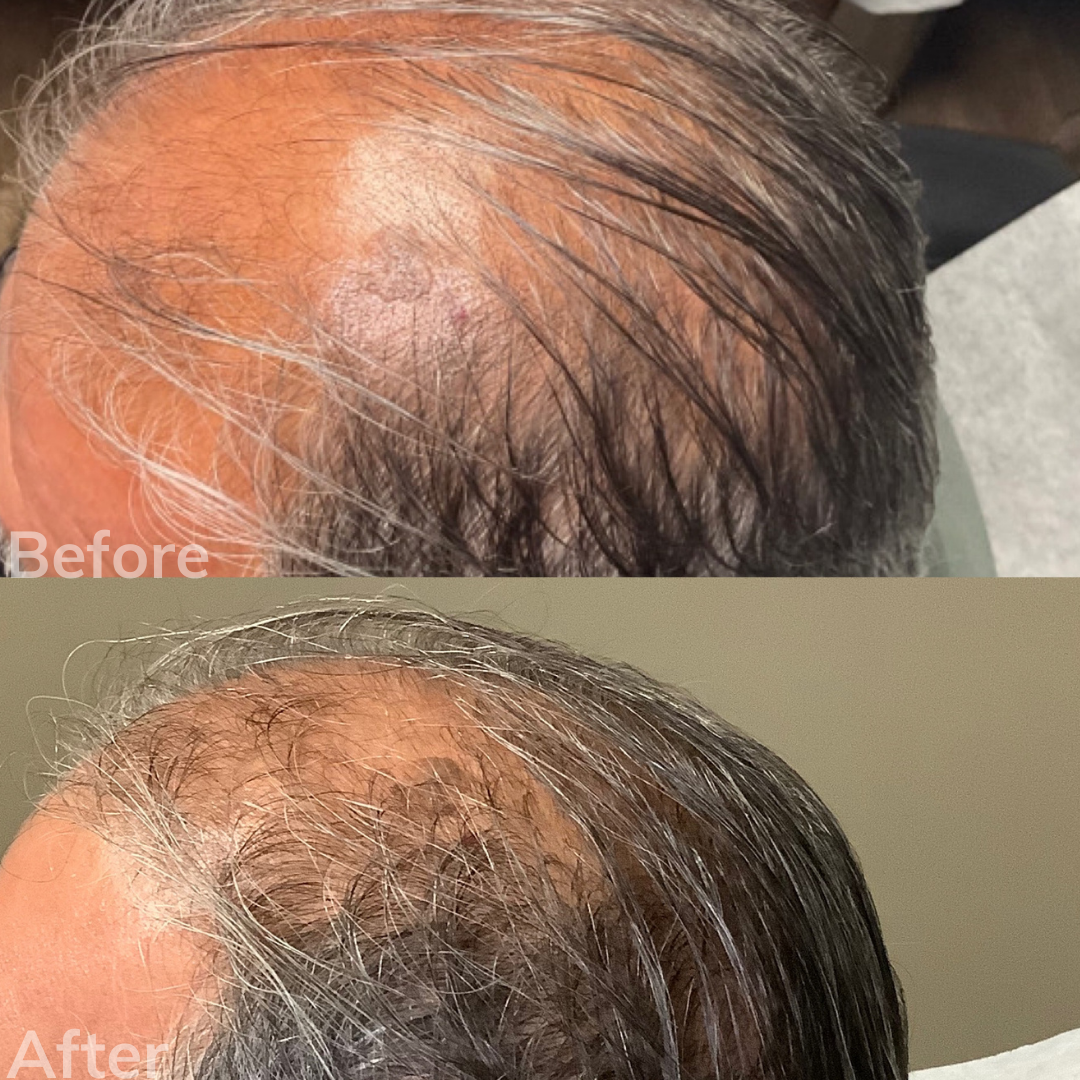Juvederm San Marcos