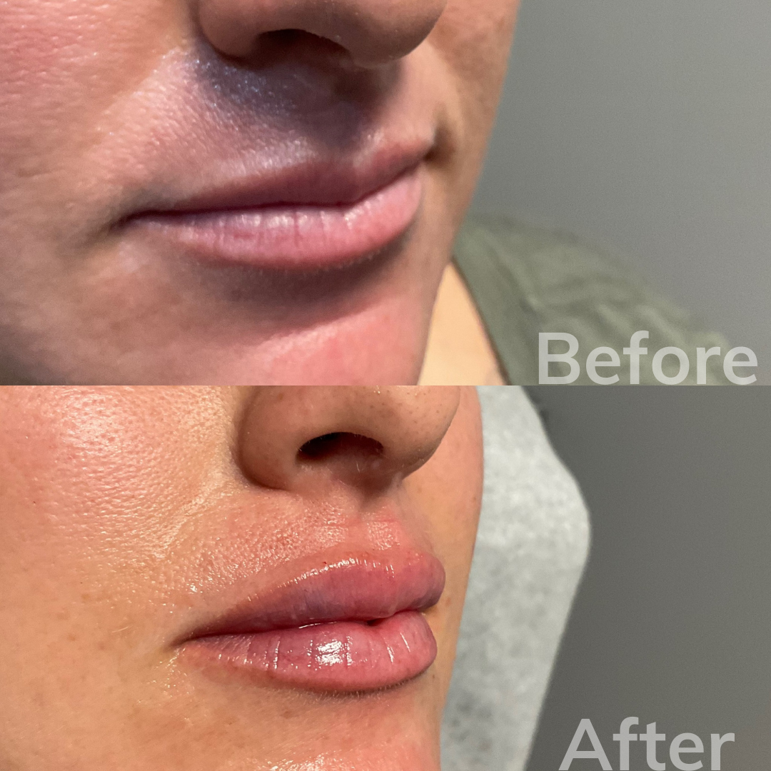 San Marcos dermal fillers