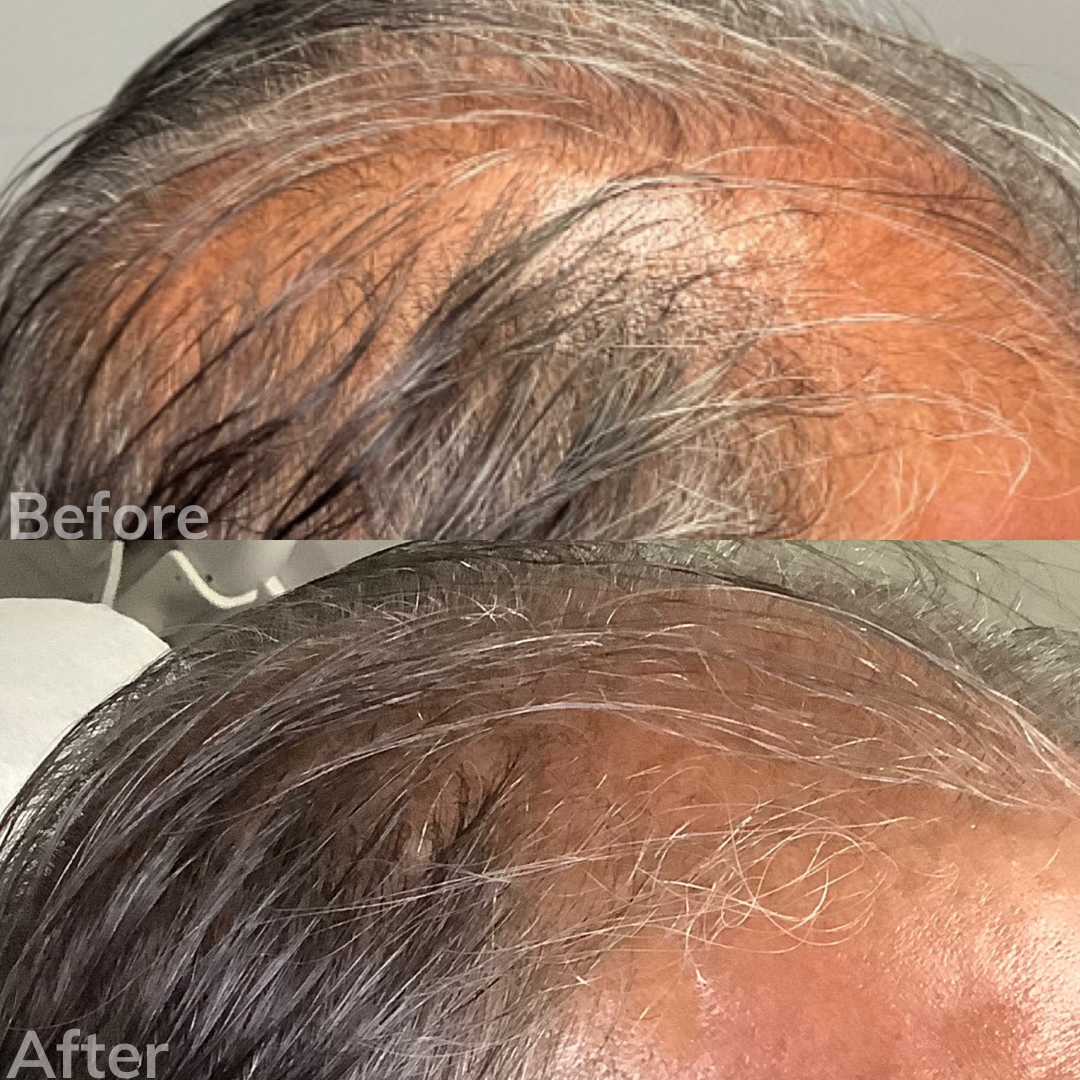 Chemical Peel San Marcos