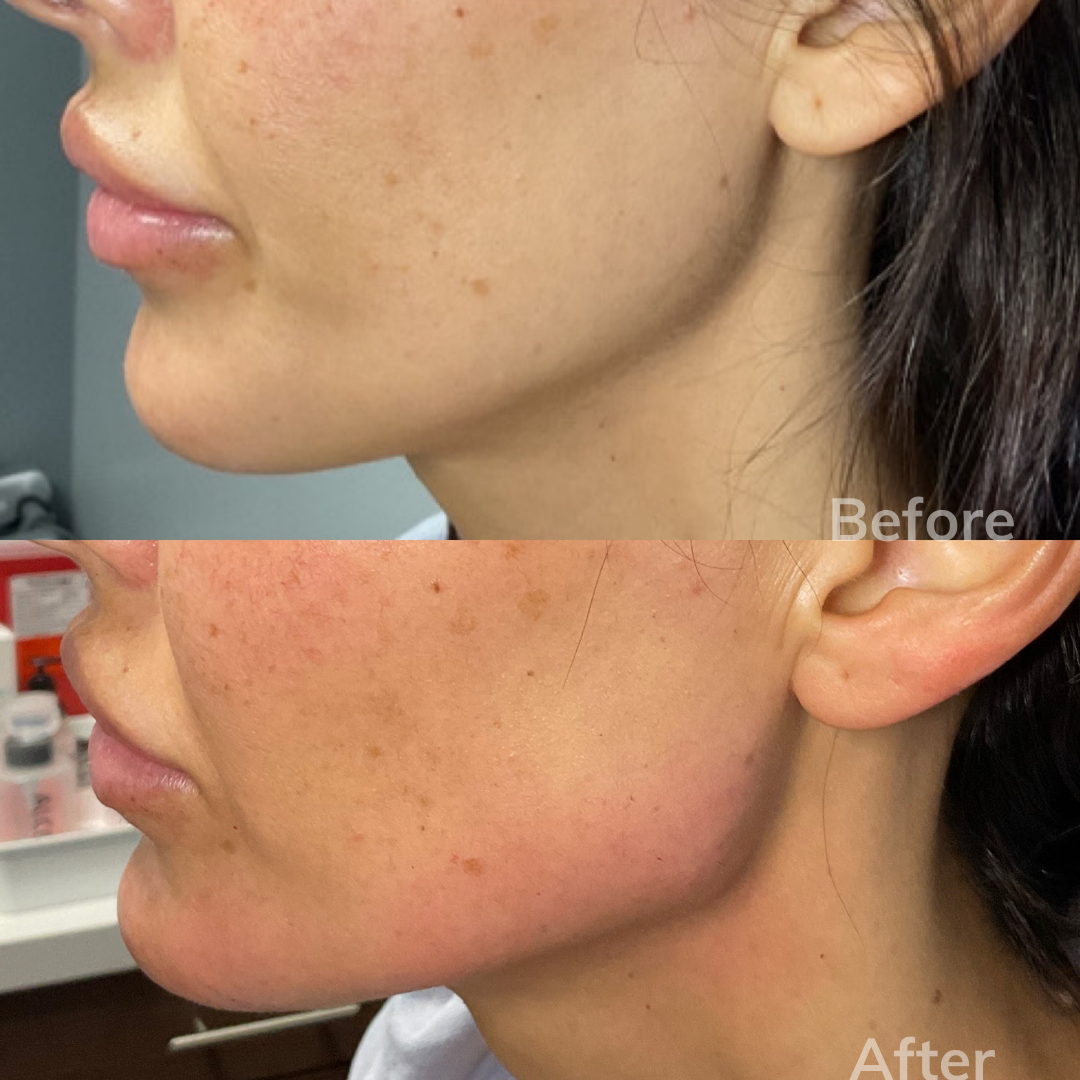 San Marcos dermal fillers