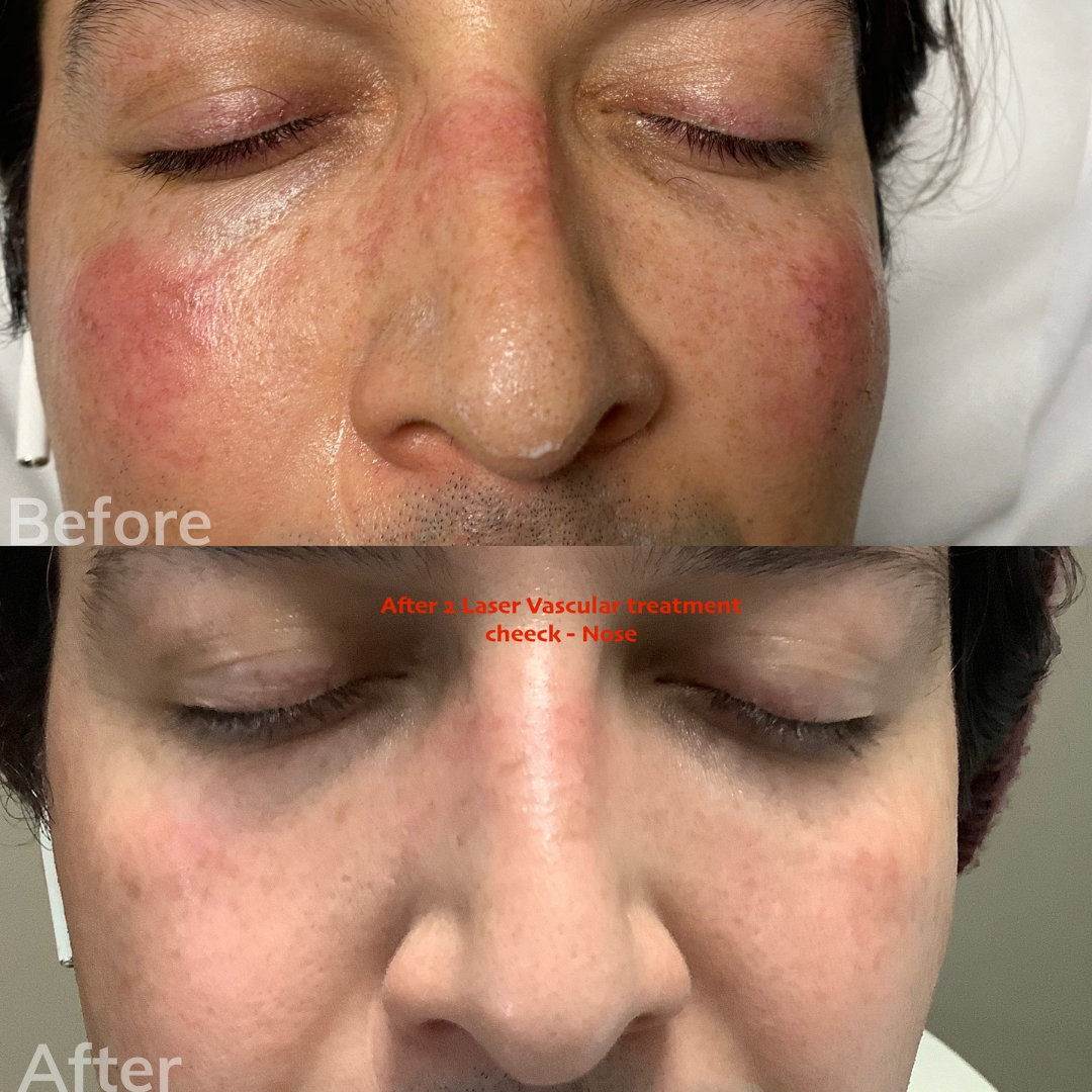 Tear Trough Filler San Marcos