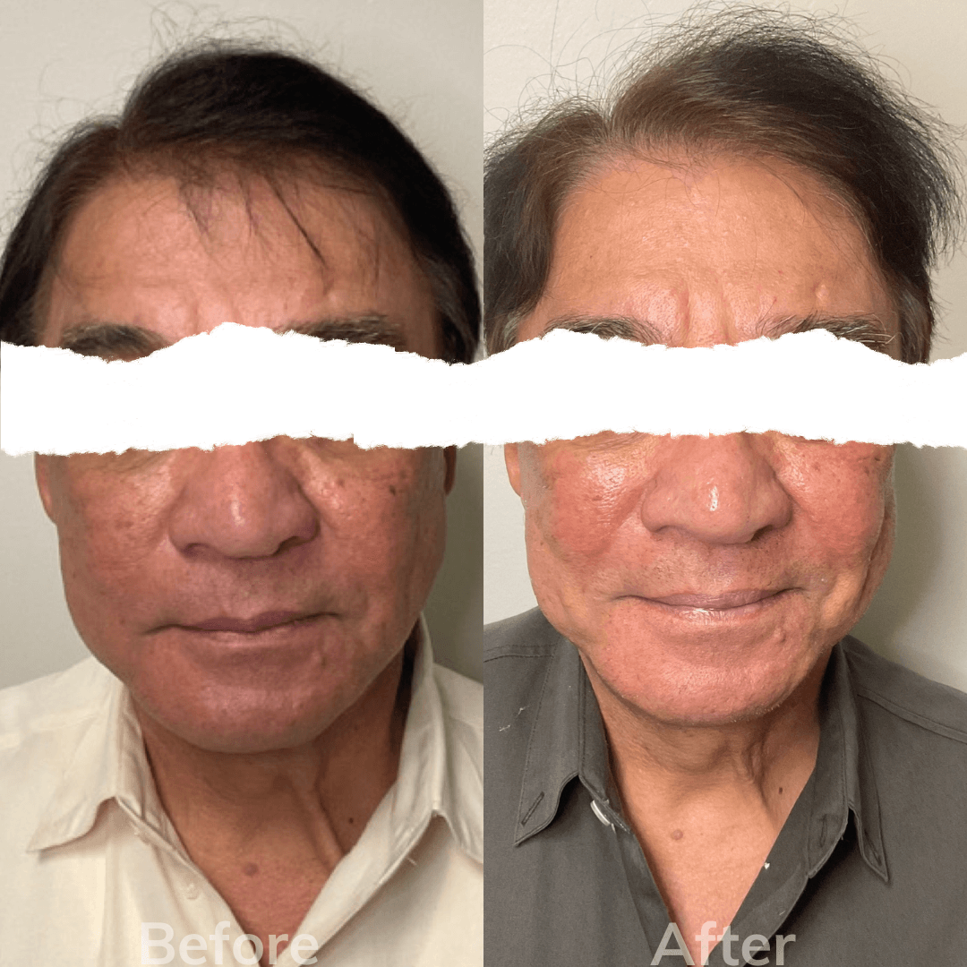 RF microneedling male san marcos