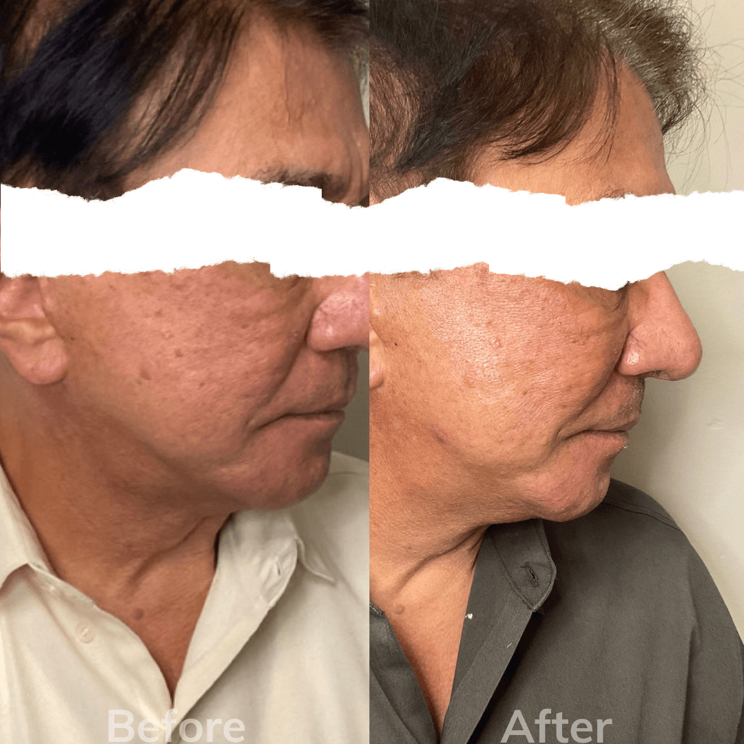 A before and after photo of a man 's face