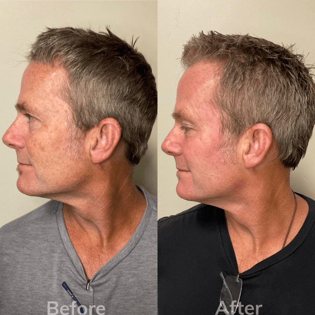 Eye Filler San Marcos