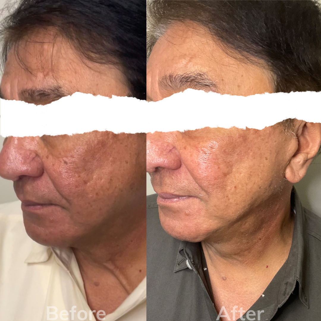 RF microneedling male san marcos