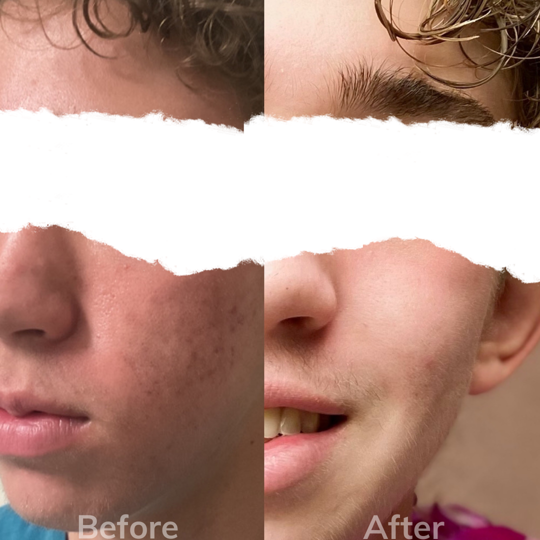 RF microneedling teen male san diego