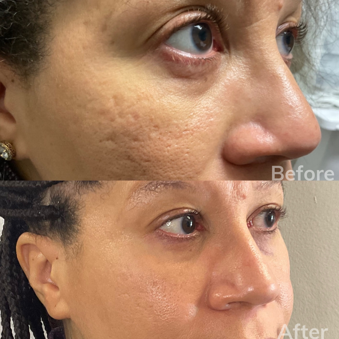 A before and after photo of a woman 's face.