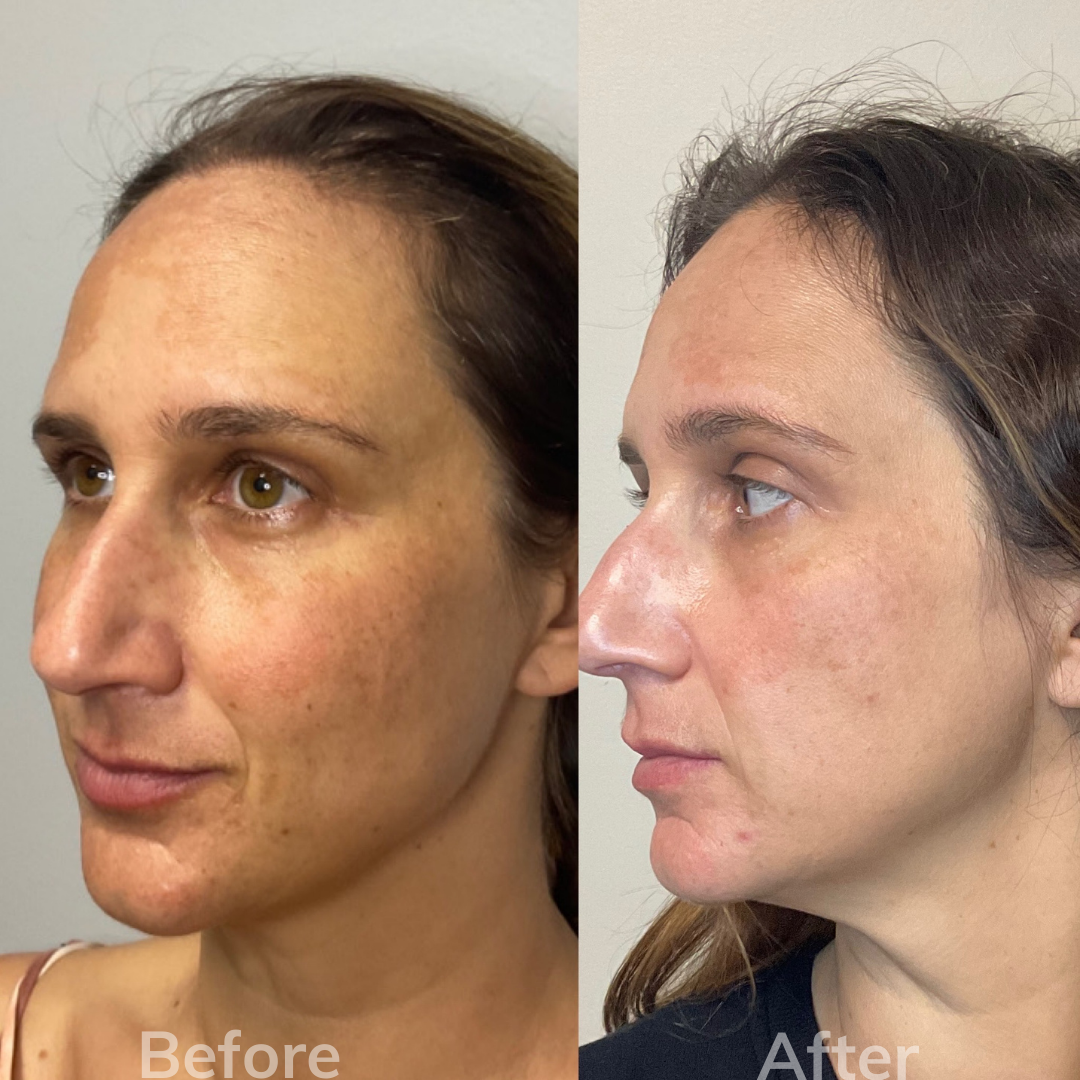 Cosmetic Eye Filler Carlsbad