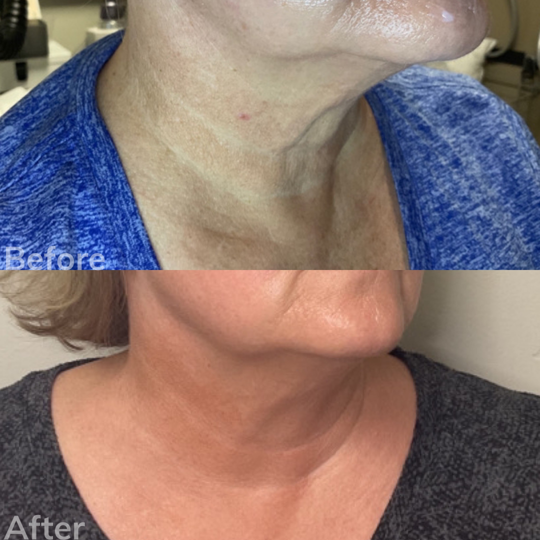 Turkey Neck Cosmetic Solutions