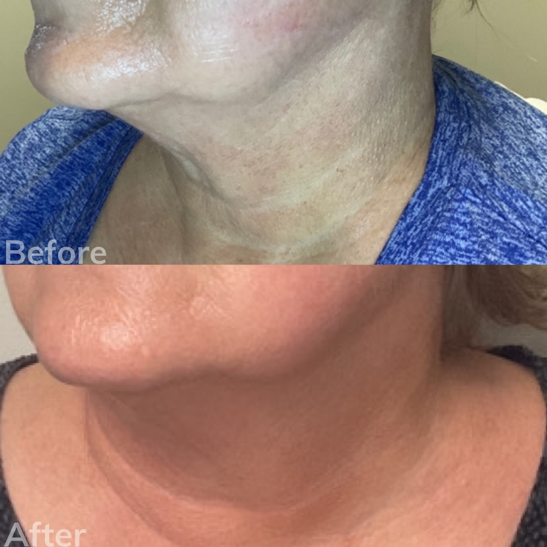 Laser Wrinkle Treatment