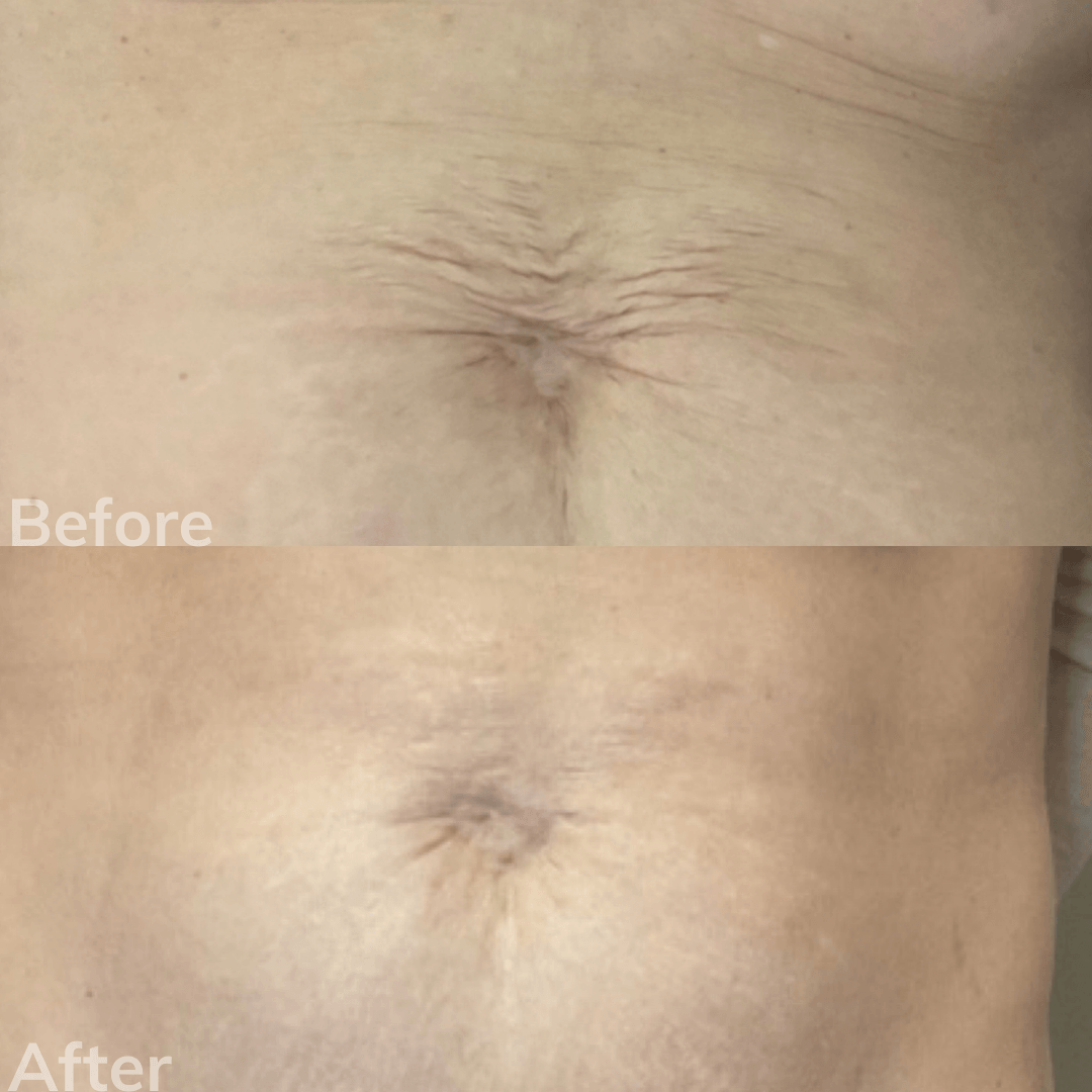 Best Dermal Fillers San Marcos