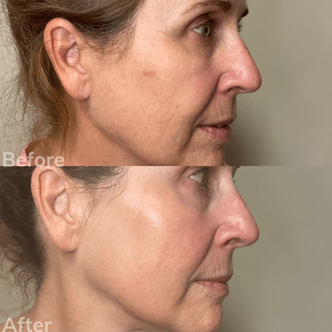 A before and after photo of a woman 's face.