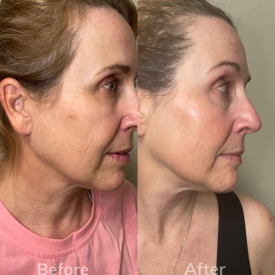 A before and after photo of a woman 's face.