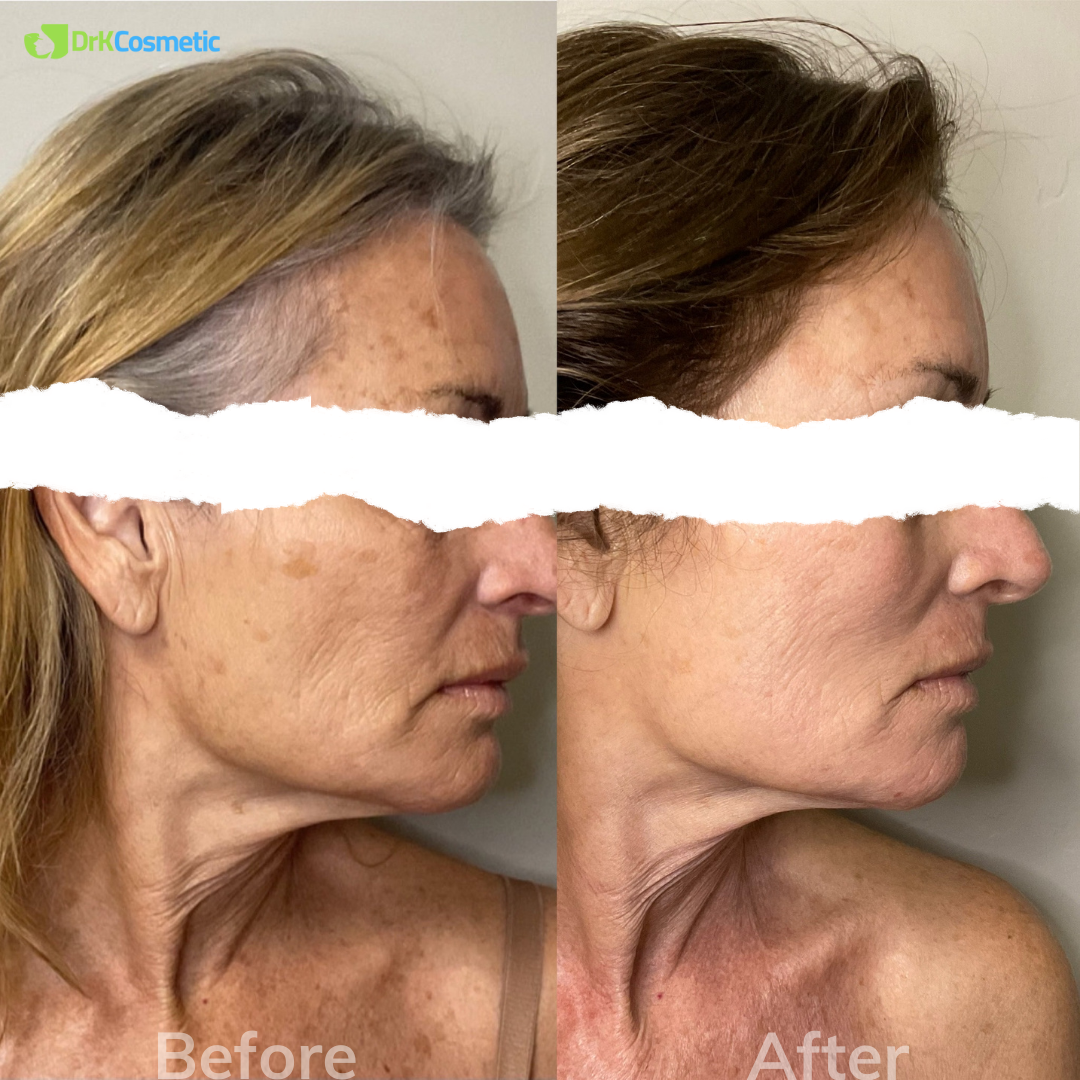 Eye Filler Carlsbad