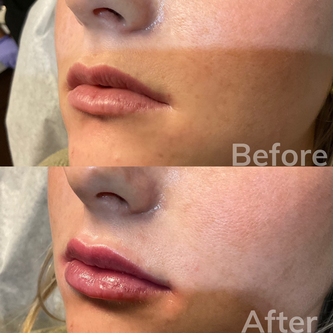 San Marcos dermal fillers
