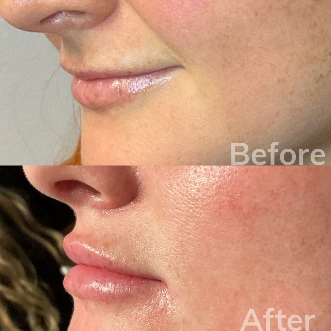 San Marcos dermal fillers