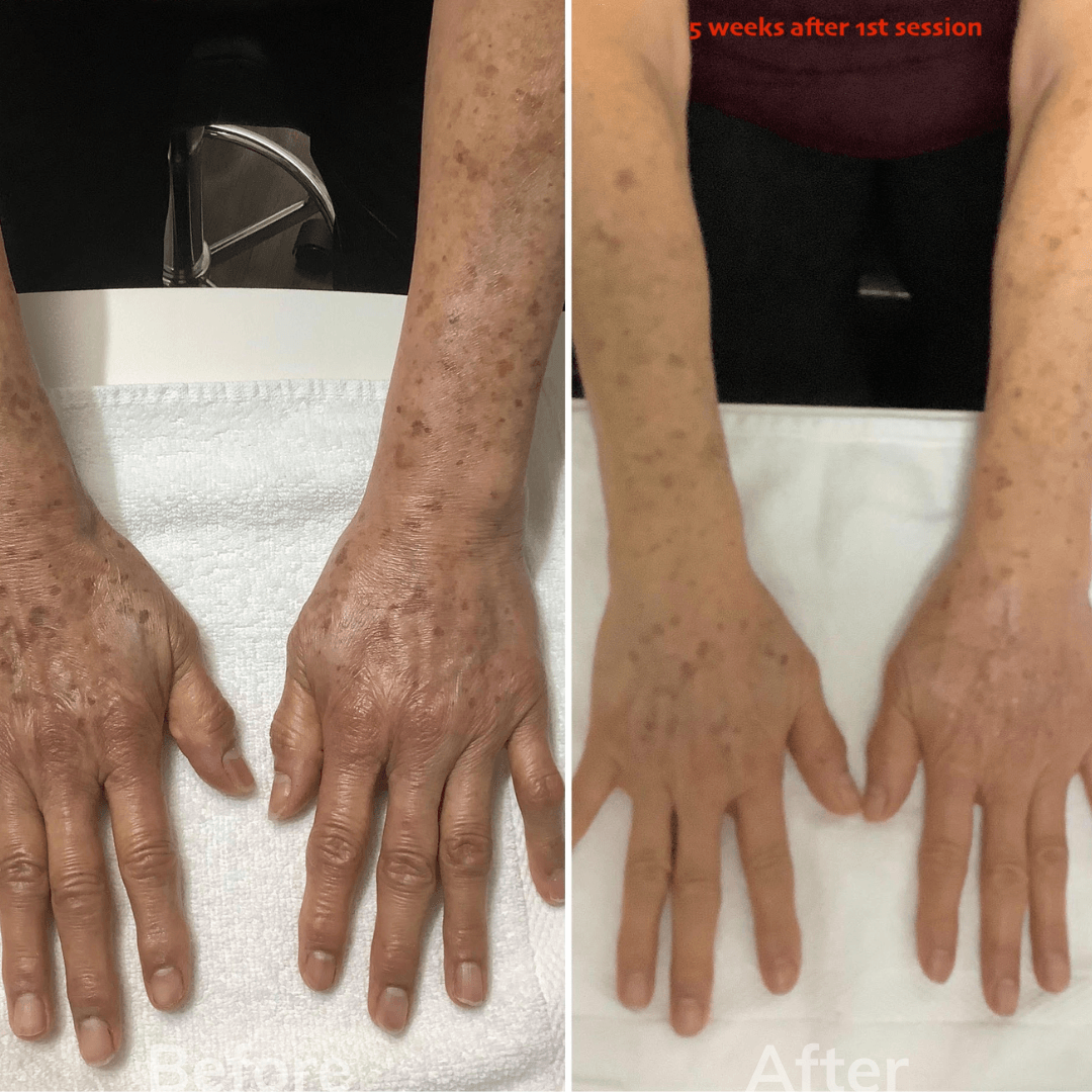 Dermal Fillers San marcos