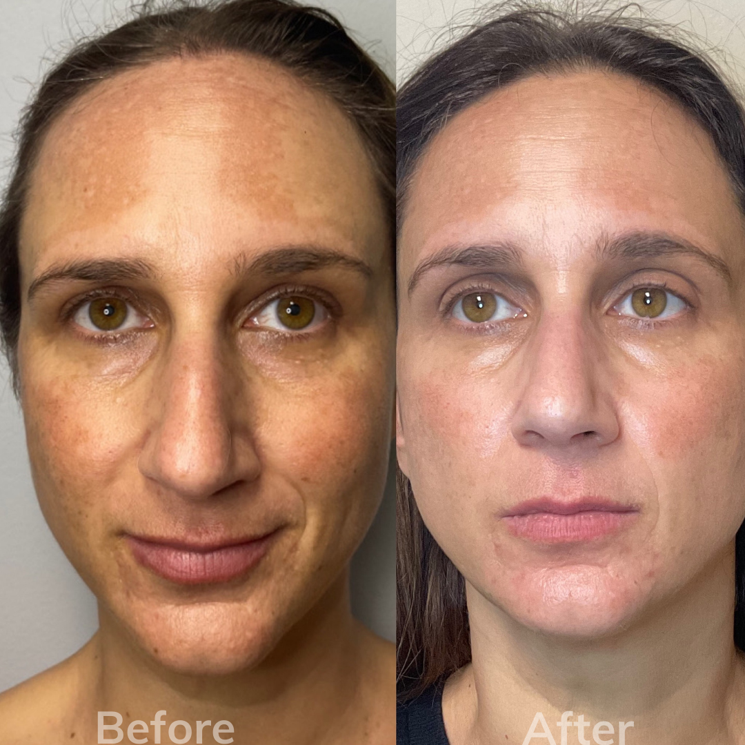 Facial Filler Carlsbad