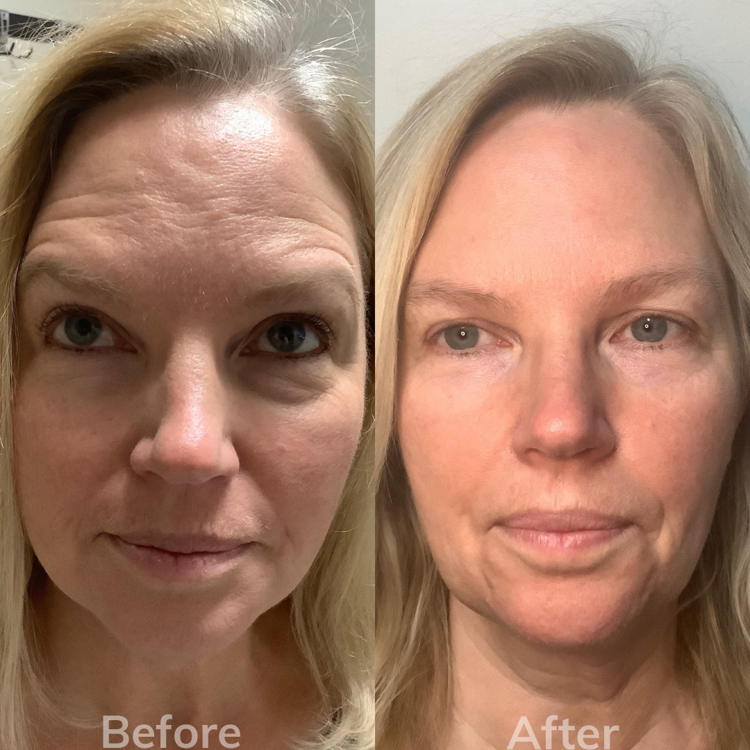 Cosmetic Facial Filler