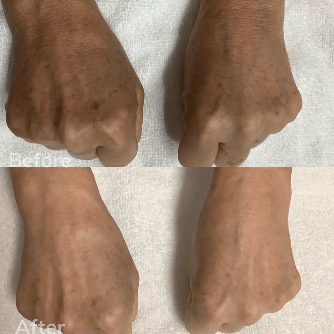 Laser Wrinkle Treatment San Marcos