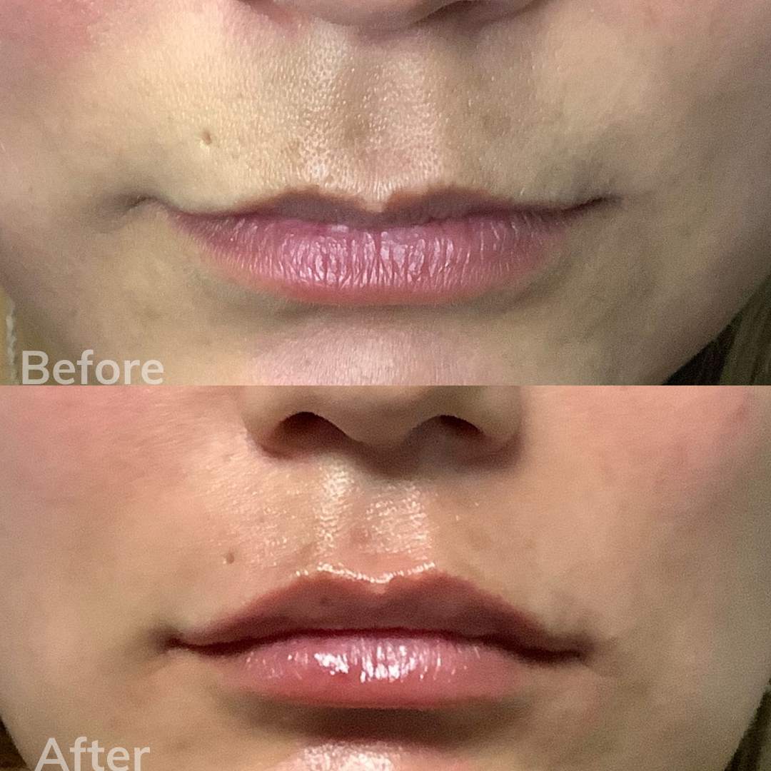 San Marcos dermal fillers
